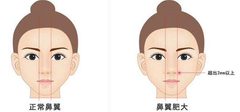 二、重庆缩鼻翼不要网红风,主打自然感:你该怎么选医生?