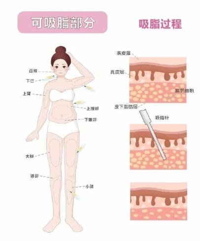 三、2026年价格实探:西安画美4800元起,对比美莱、叶子透明在哪?www.51aimei.com