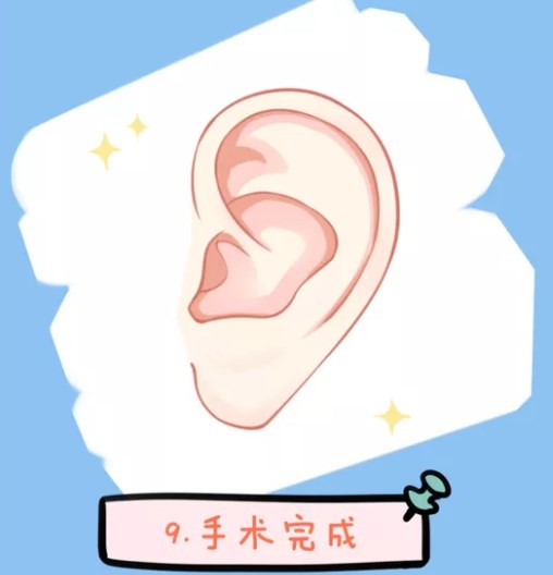 实例一：先天性小耳畸形三期耳再造