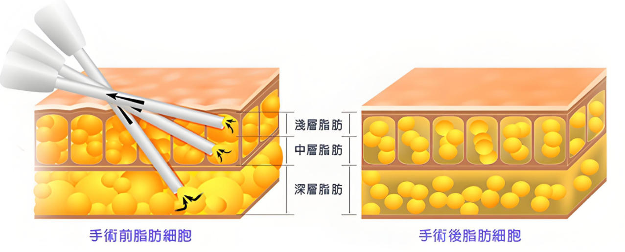 四、做脂肪项目韦元强和王明利实例疗效与求美者口碑:真实反馈说话