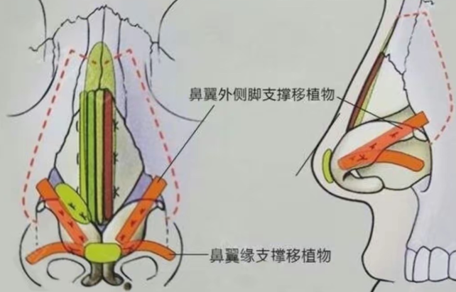 1. 技术优势：分层减张缝合，做完内切完全无疤