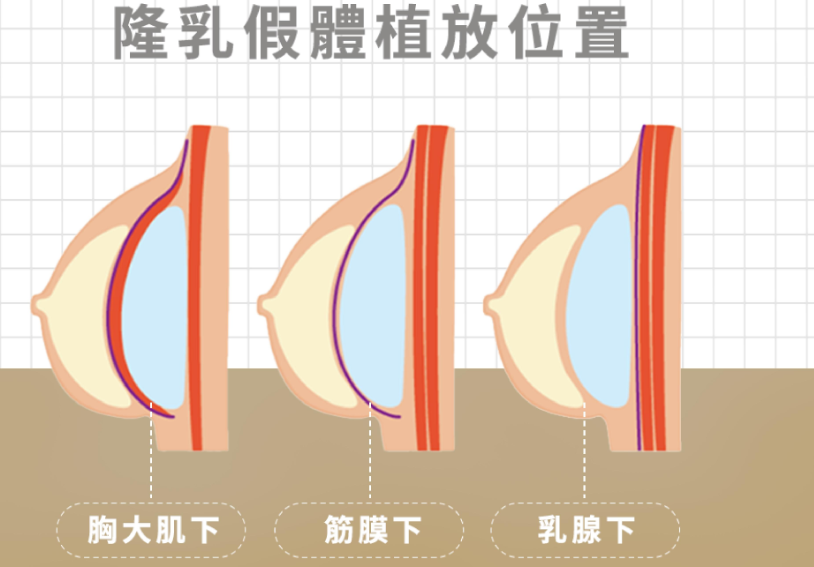 四、除了医生，在长沙艺星做隆胸还需要了解这些关键细节