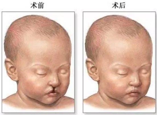 四、余文林唇裂修复常见问题解答www.51aimei.com