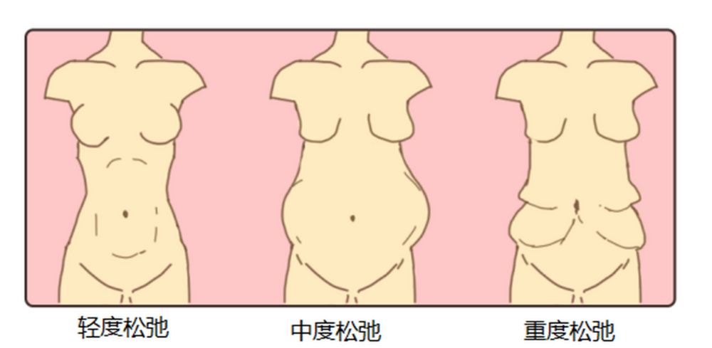 找李献和做腹壁整形联合腰腹吸脂会更划算吗？切皮吸脂打包价参考