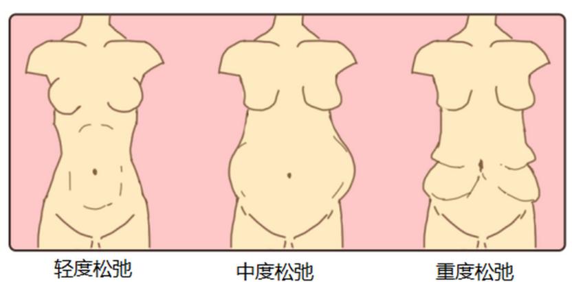 头一次做腹壁整形手术面诊,任杰医生会重点评估哪些指标?