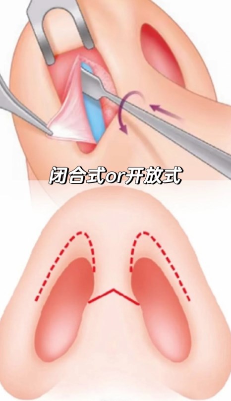 四、关于李保锴医生做鼻子的常见问题解答(FQA)