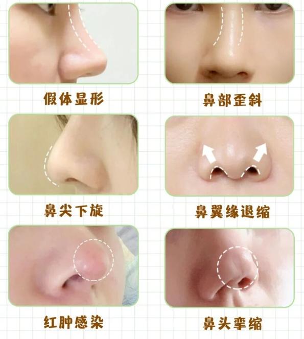 四、选择李保锴进行鼻修复的注意事项