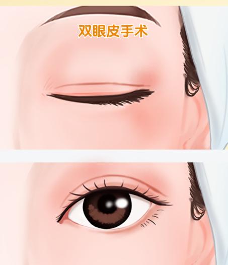 1. 核心技术：S-ACC生理性睑板前多点定位技术