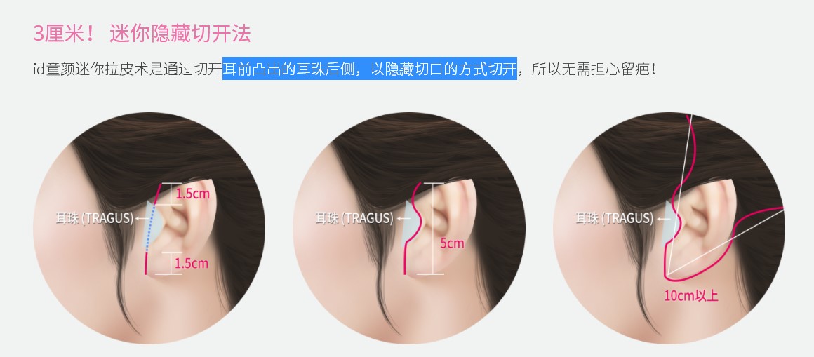 三、网友亲测V9疤痕隐形8年反弹几率小,V6提升4.3万起疗效自然,是真是假?