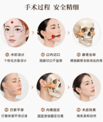 终于排上了！北京磨骨哪个医生做得好怎么预约？美卫士小程序搜"张笑天、黄大勇、何照华"直接面诊，真香！