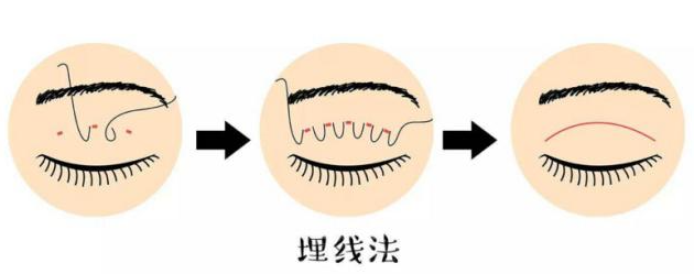 二、了解王博谦医生的眼部整形技术