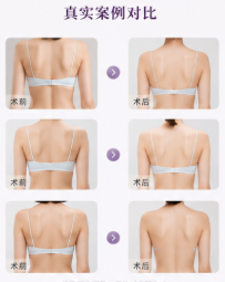 3. 多层次立体注射：拒绝“一团死肉”
