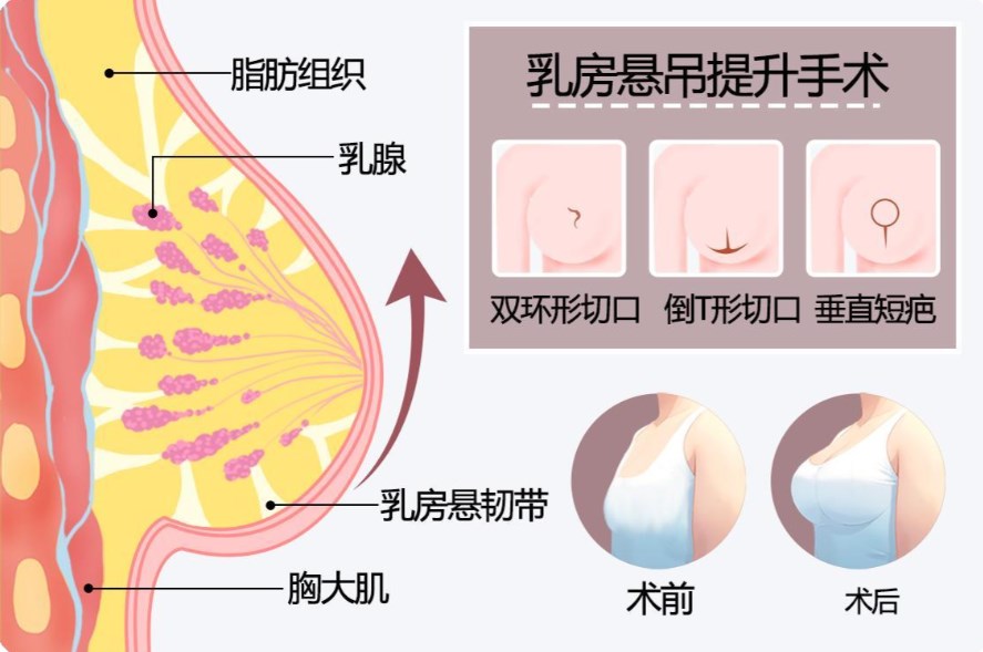 冯斌自体脂肪丰胸为什么那么贵