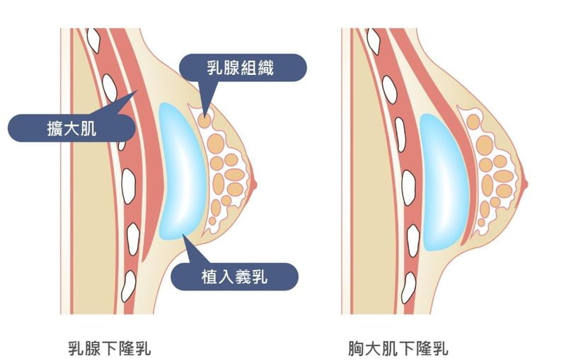 一、苏州李寅隆胸怎么预约www.51aimei.com