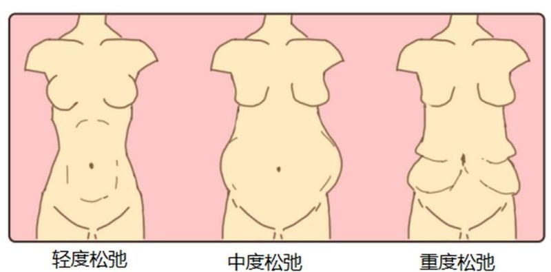 三、重庆杨光智腹壁整形的五种技术方案对比