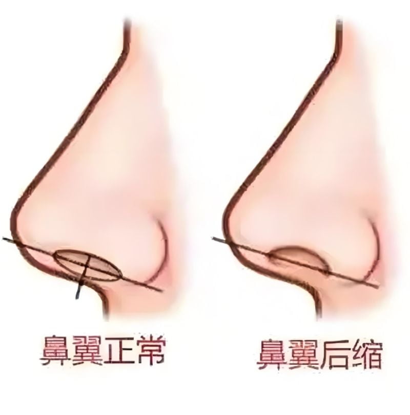 二、童列健医生的鼻整形技术特色