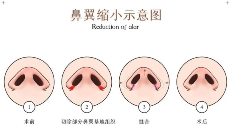 三、在苏州找童列健做鼻子的流程与价格