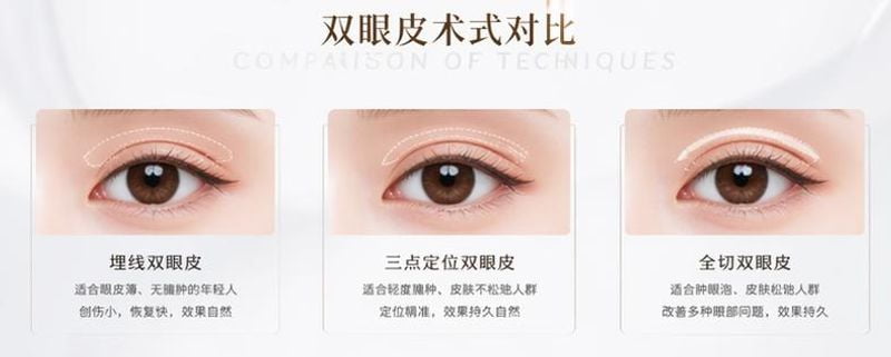 杭州艺星杨连华做双眼皮怎么样?扒一扒“三层解剖复位技术”