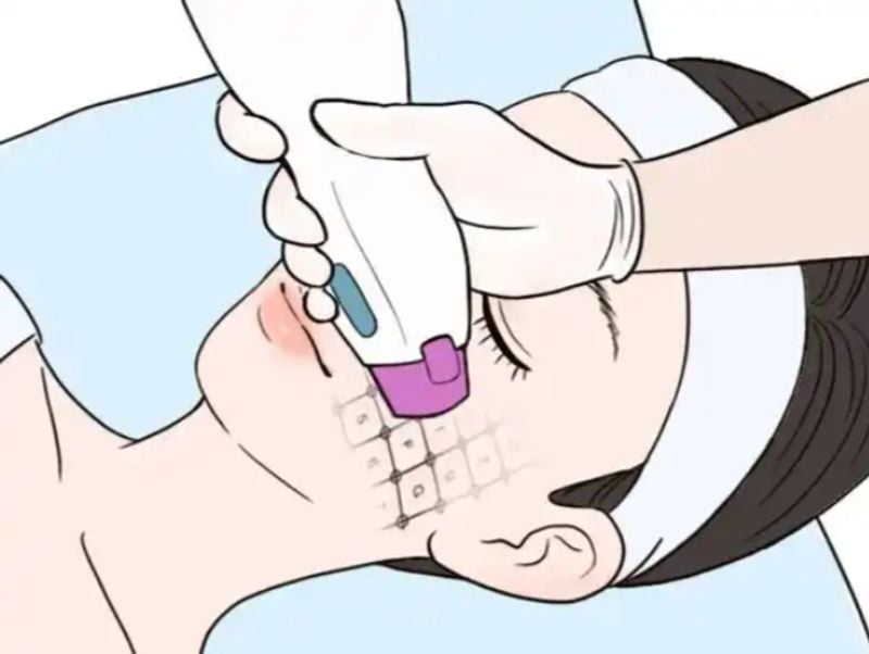 温州和平吴丽微医生做超声炮好在哪里？