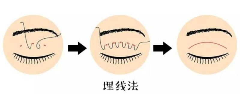 二、在张家界维纳斯做双眼皮，如何判断医生是否适合自己