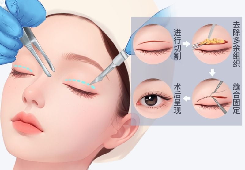 3. 高难度双眼皮失败修复的“拆弹医生”