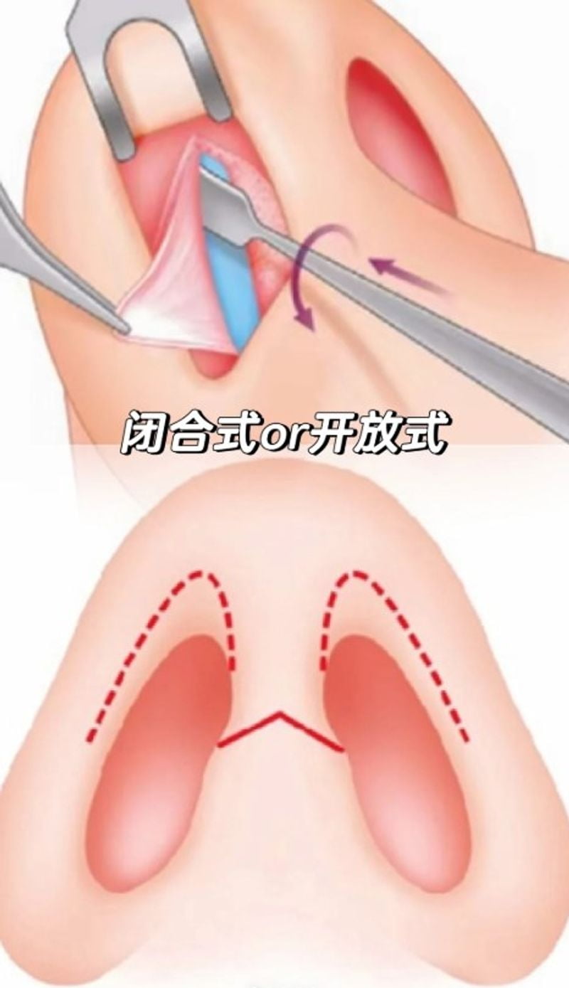 四、王旭明隆鼻与鼻修复技术详解:好在哪,适合谁?