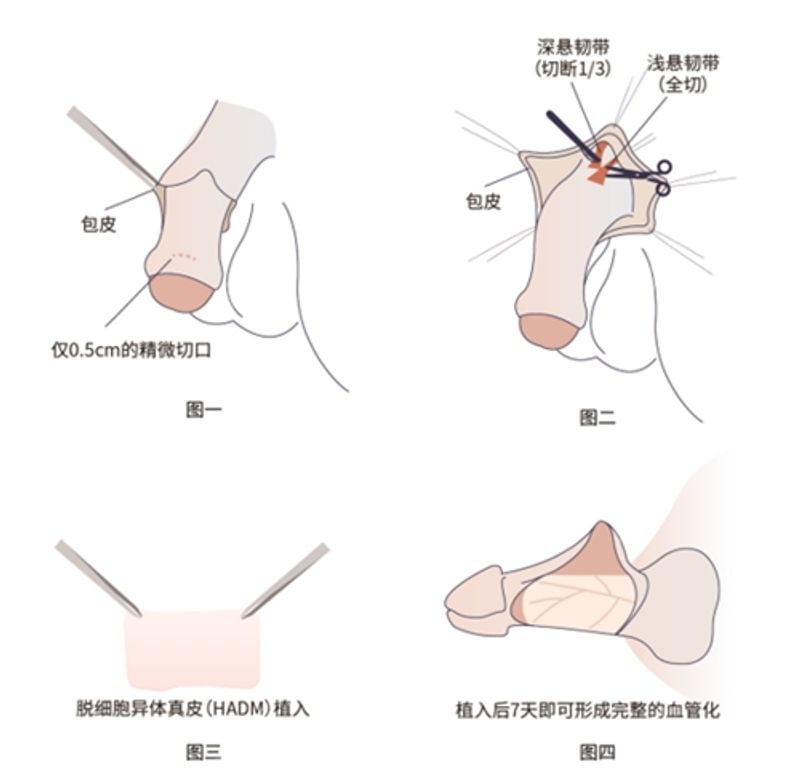 张权延长增粗预约挂号前，先去美卫士看真实底细：保留背神经专利 + 增粗3-5cm可见