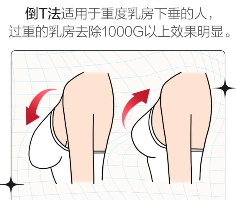 如何利用美卫士规避巨乳缩小手术中的隐形消费与避坑指南www.51aimei.com