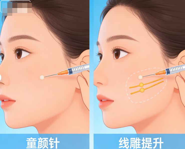 关于闫海廷苹果肌填充的常问问题