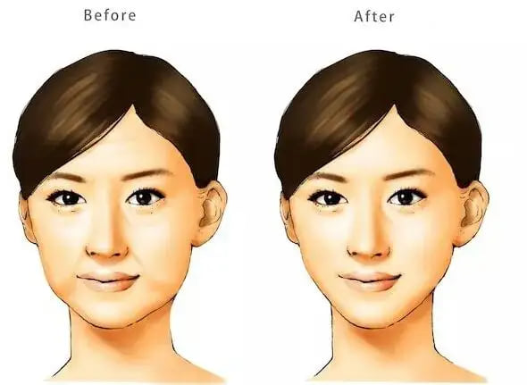 二、厦门华美352元起的1ml海薇M+玻尿酸适合做哪些部位?