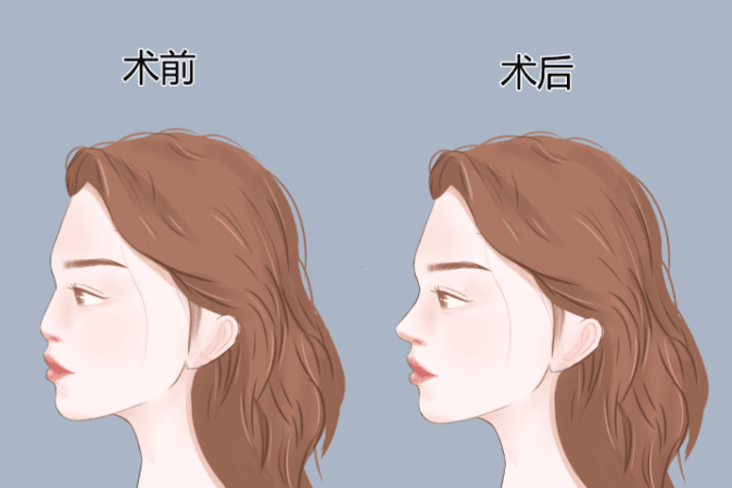 一、株洲丽人玻尿酸隆鼻到底怎么样？适合哪些人？www.51aimei.com