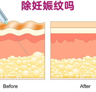 拒看精修图！余永利妊娠纹修复有人去过吗？北京余永利妊娠纹真实测评原相机曝光！
