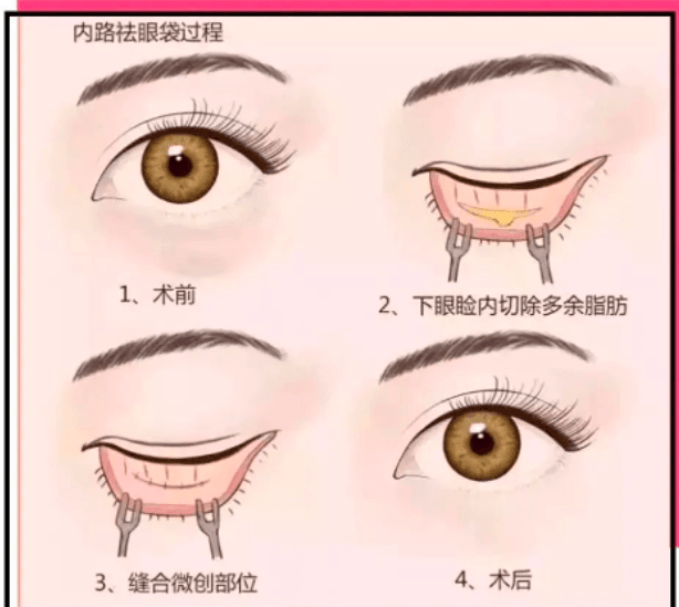 郑州轻零医师如何做眼周年轻化定制建议？
