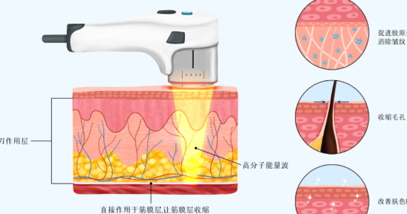 抗衰保养怎么做才能少花冤枉钱?郑州芊美整形超声炮预约指南及省钱秘籍,去美卫士限时抢订优惠名额