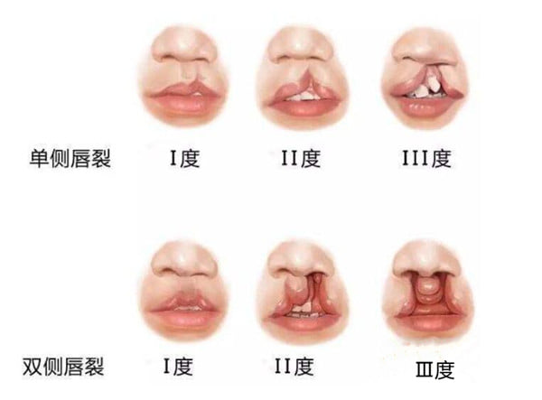 广州高尚唇裂修复中心联系方式：400-832-0168通话直约余文林不跑空！