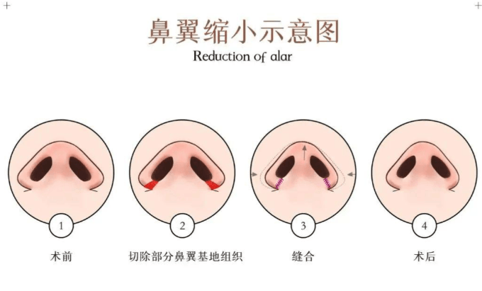 三、如何判断自己是否适合在长沙艺星做鼻翼缩小？
