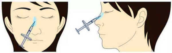 担心材料移位跑偏?厦门荟美天成医疗注射隆鼻好吗?骨膜层定点包裹强支撑,真实案例对比技术亮点
