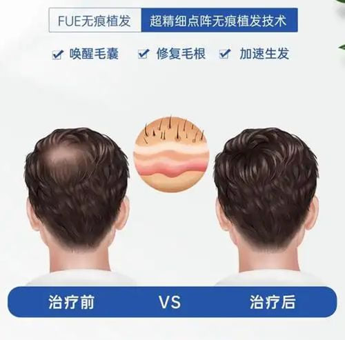 微针与宝石刀技术,究竟如何影响你的较终花费