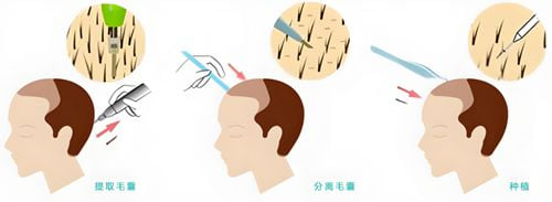 总结:如何理性看待发际线种植的费用与选择