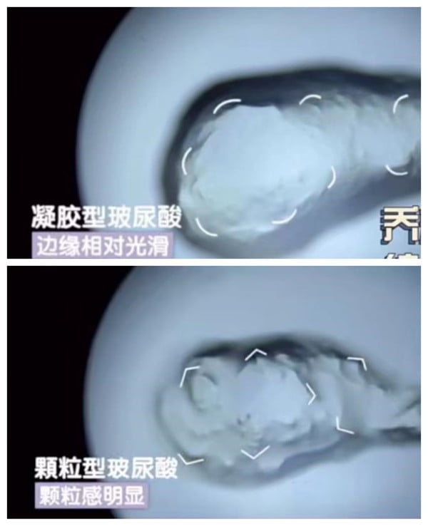 四、玻尿酸打下巴全流程与术后疗效维持攻略