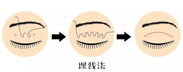 二、手术类项目常见疑问