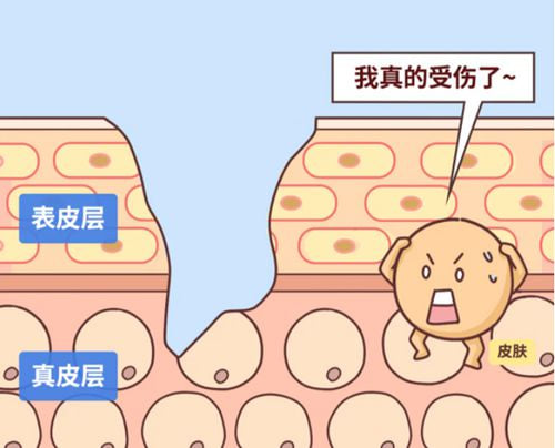 珠海科美刘彤祛疤好吗?旧疤不红不凸也能改善,点阵激光做三次质地变软