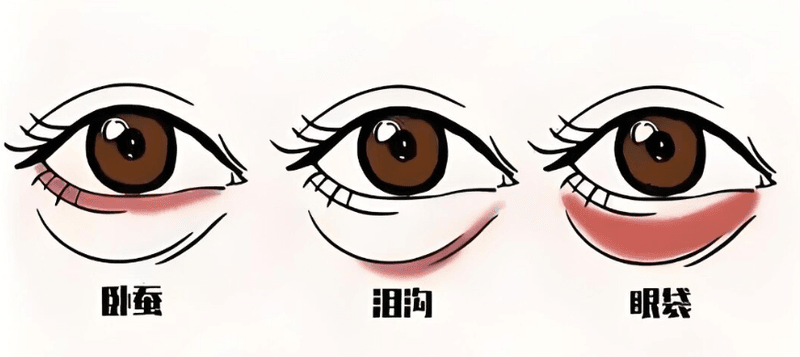 一、宁波颜蕾医美琚松医生打卧蚕技术拆解:优势与局限同存